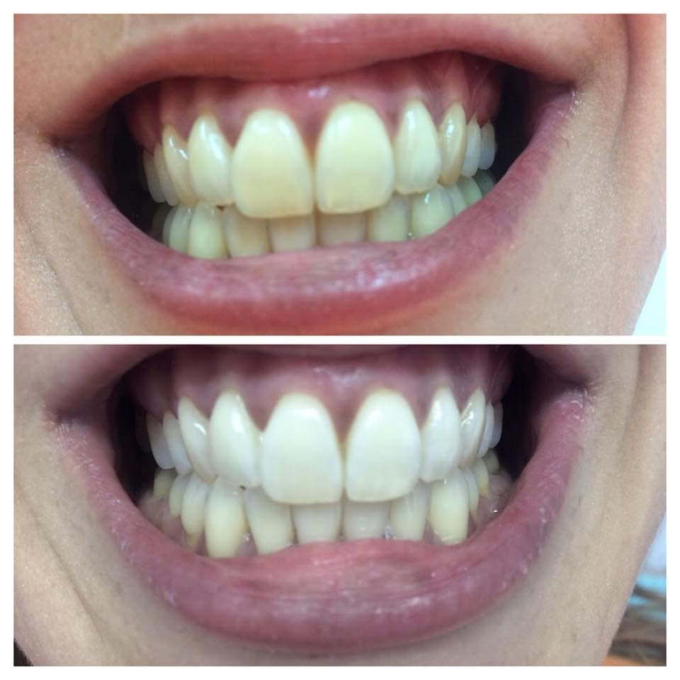 Dental Choice — keramičke krunice