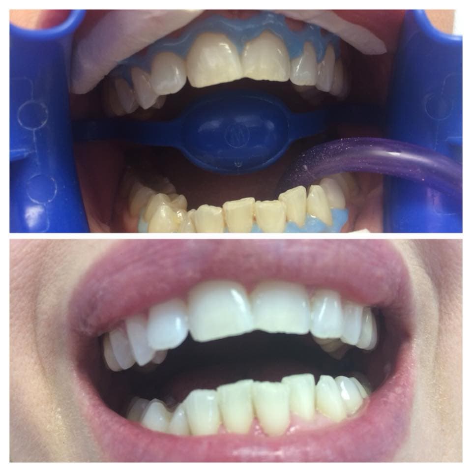 Dental Choice — beljenje zuba
